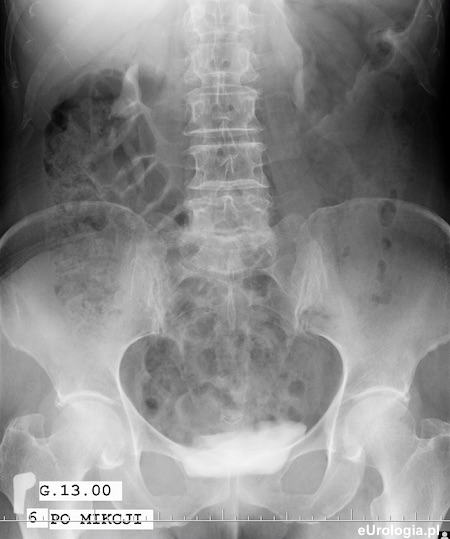 Kamica nerkowa - kamica miedniczki w urografii