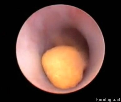 Zł&oacute;g z kwasu moczowego niewidoczny na zdjęciu RTG