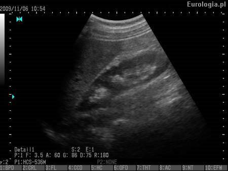 USG jamy brzusznej - nerka prawa