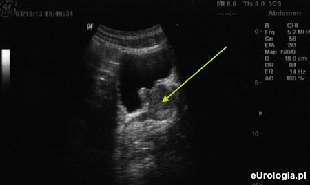 USG gruczołu krokowego - przekr&oacute;j poprzeczny