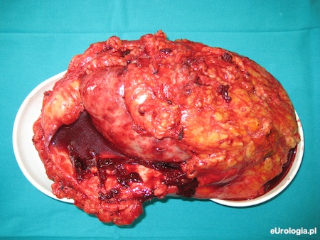 Usunięcie nerki - preparat z nefrektomii