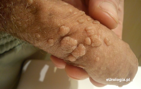 HPV - zmiany skórne prącia
