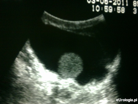 Wodniak jądra - obraz USG