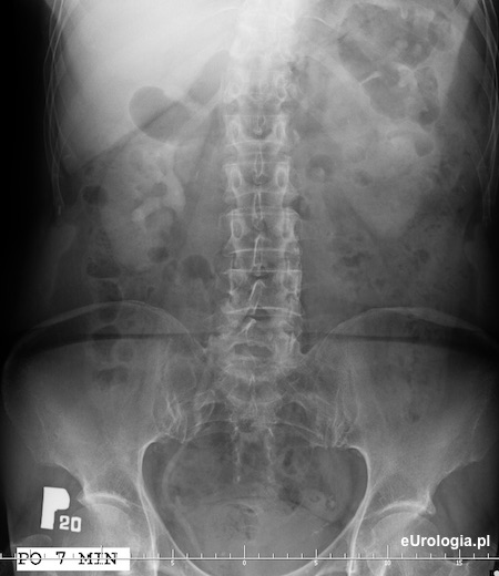 Zł&oacute;g w dolnym odcinku moczowodu - wodonercze w urografii