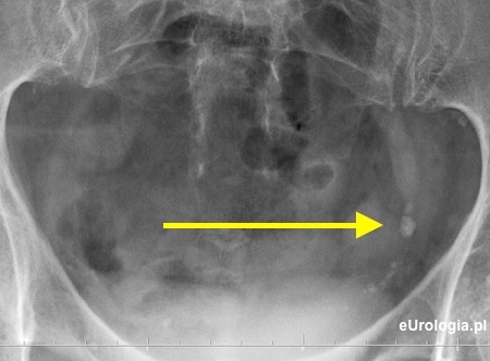 Kamica moczowodowa - wodonercze