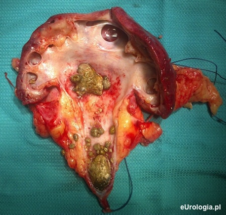 Skrajne wodonercze w przebiegu kamicy