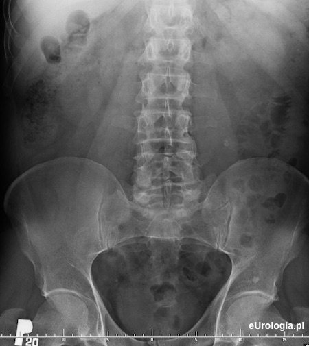 Kamica moczowodowa - wodonercze