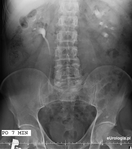 Wodonercze - kamica g&oacute;rnego odcinka moczowodu