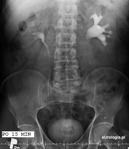 Wodonercze lewostronne w przebiegu kamicy g&oacute;rnego odcinka lewego moczowodu. Urografia - zł&oacute;g w g&oacute;rnym odcinku moczowodu i zwężenie moczowodu.