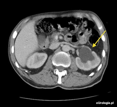 Wodonercze lewostronne - obraz w tomografii komputerowej