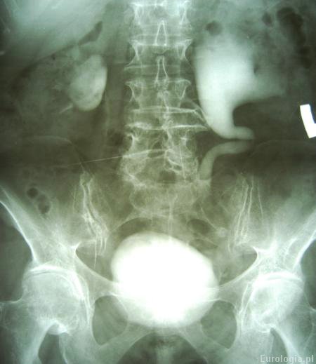 Wodonercze - urografia