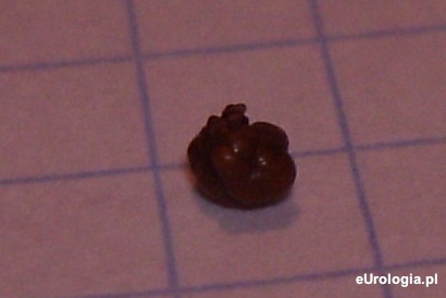 Wysikany kamień z nerki - zdjęcie