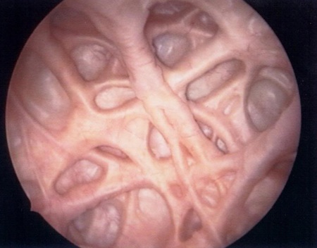 Powikłania przerostu prostaty - wzmożone beleczkowanie