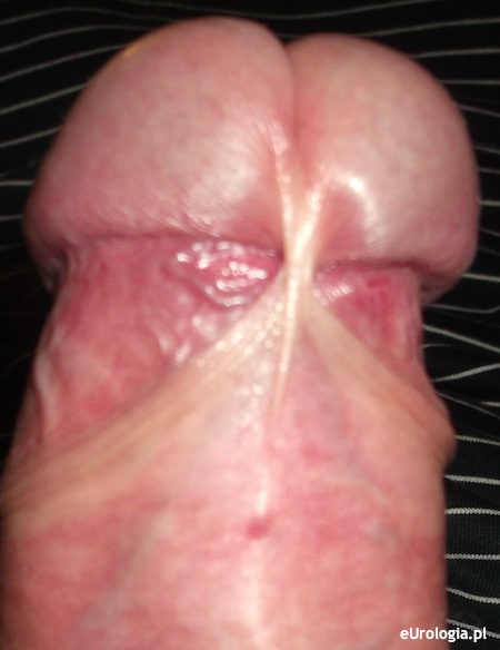 Kr&oacute;tkie wędzidełko - zdjęcie