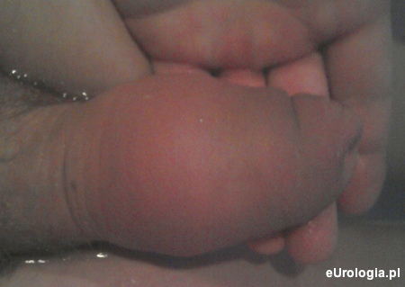 Obrzęk prącia - zapalenie w przebiegu stulejki