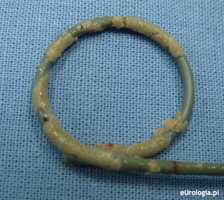 zatkany cewnik DJ - kalcyfikacje