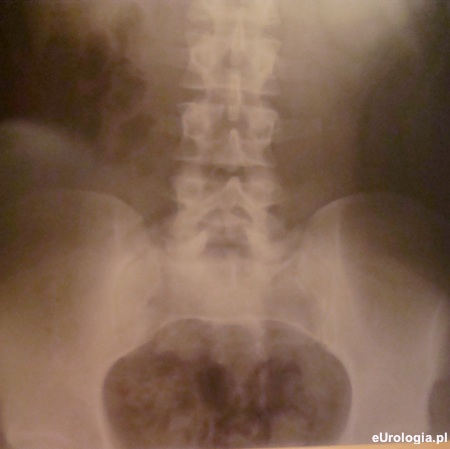 Zdjęcie kamieni w nerce