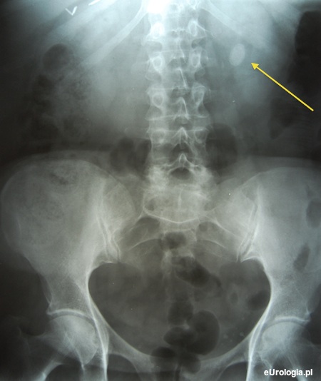 Zdjęcie przeglądowe brzucha - kamień w miedniczce