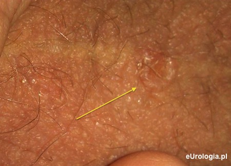 Zmiana sk&oacute;rna - szew moszny