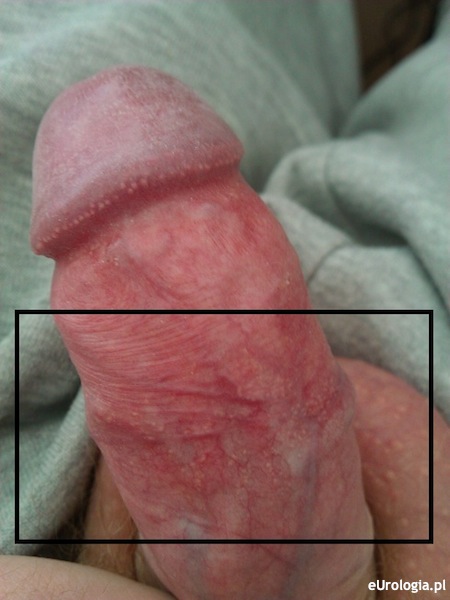 Zmiany na sk&oacute;rze penisa