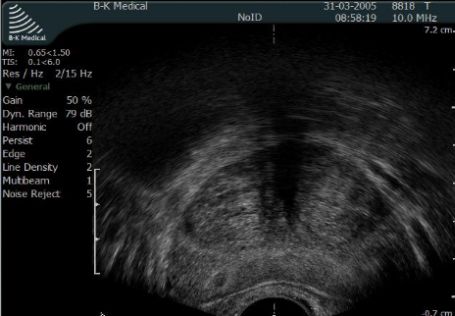 Zwapnienia w gruczole krokowym w transrektalnym USG stercza
